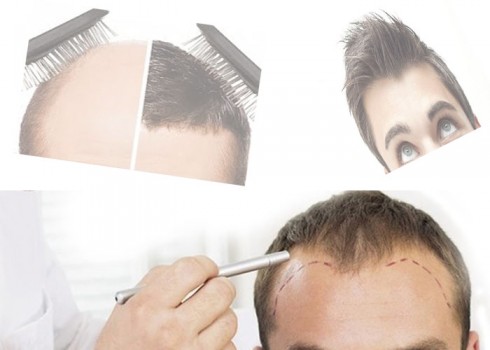 Hair Transplant